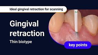 Thin biotype  Ideal gingival retraction for scanning