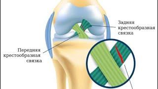 Разрыв задней крестообразной связки. Реабилитация. Упражнения.