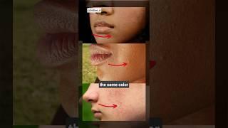 Acne - Whiteheads Explained #acne #whiteheads