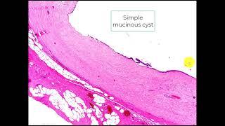 Simple mucinous cyst Pancreas