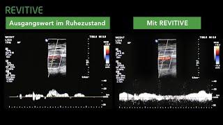 Revitive - Professor Mark Whiteley Shows the Revitive Circulation Booster® in action