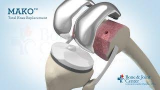 Full Knee Replacement  Mako Robotic Arm Assisted Surgery Technology