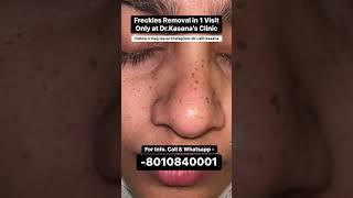 Freckles Removal 1 Visit only at Dr. Kasanas Clinic