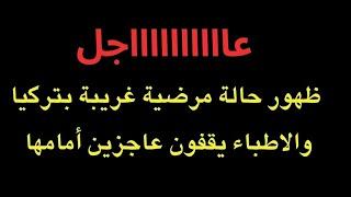 عاجل  ظهور حالة مرضية غريبة في تركيا والطب يعجز أمامها