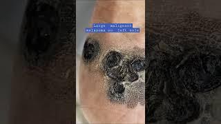 Deadly skin cancer  melanoma  #shorts