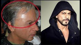 Bollywood Stars Hair Transplant  fut hair transplant  hair transplant in pakistan