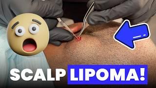 SCALP LIPOMA