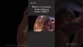 What is a Coronary Artery Bypass Graft CABG? #shorts