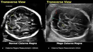 Edwards Syndrome Trisomy 18 Antenatal Ultrasound Features  Fetal USG Normal Vs Abnormal Images