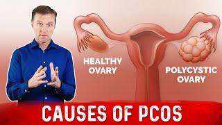 3 Causes of Polycystic Ovarian Syndrome PCOS & High Androgens – Dr. Berg