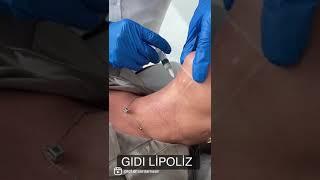 GIDI LİPOLİZ