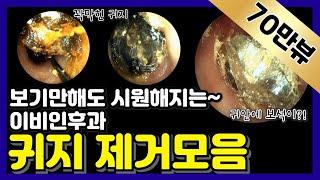 보기만해도 시원해지는 이비인후과 귀지 제거 모음 Earwax Removal