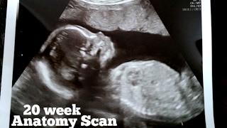 20 week Ultrasound Anatomy Scan  Lani