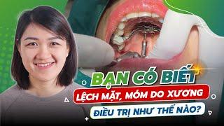 NIỀNG RĂNG CHỮA MÓM DO XƯƠNG - LỆCH MẶT Ở NGƯỜI TRƯỞNG THÀNH DIỄN RA NHƯ THẾ NÀO?