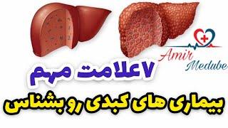 ۷ علامت مهم بیماری کبدی هپاتیت مثل کبد چرب چیست؟ من کبد چرب دارم چگونه متوجه بشم؟