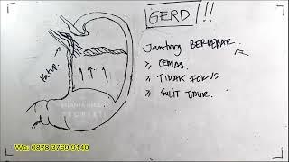 GERD  PENYEBAB SERING CEMAS DAN DEGDEGAN