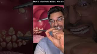 Tonsil stones removal ASMR  major bad breath 