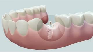 Dental Implants at North Brisbane Dental Clinic