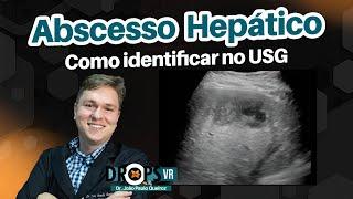 ABSCESSO HEPÁTICO - COMO IDENTIFICAR NO USG I VOCÊ RADIOLOGISTA