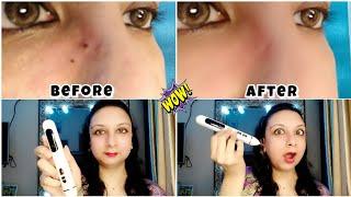 How to remove mole using mole remover pen  best product to make your skin clear #mole #skin #viral