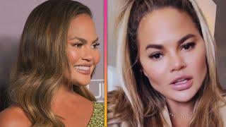 Chrissy Teigen Reveals Cosmetic Surgery on Her Face