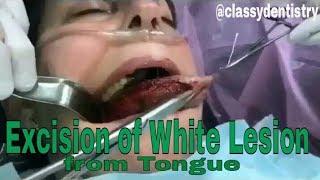 Surgical Excision of White Lesion from Lateral border of Tongue with the help of Laser .