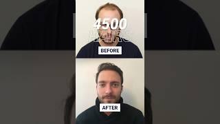 Pauls result 12 months after hair transplant #shorts #fuehairtransplant