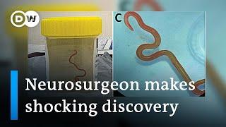 Neurosurgeon removes live worm from womans brain in world-first discovery  DW News