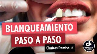  Blanqueamiento dental PASO A PASO  Antes y después - Clínica Dental Dentisalut