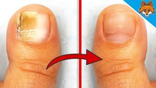 Remove Nail Fungus with THIS Home Remedy  It couldnt be easier 