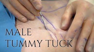 Male Tummy Tuck  Amazing After Results  Barrett Plastic Surgery in Beverly Hills