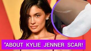 TRUTH ABOUT KYLIE JENNERS SCAR