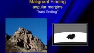 Solid Breast Nodules Benign vs Malignant