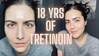 Not Seeing Results with Retin-A TRETINOIN? Watch This Before You Quit & Avoid My Biggest Mistake