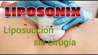 ¡Transforma tu Figura sin Cirugía Conoce El Liposonix