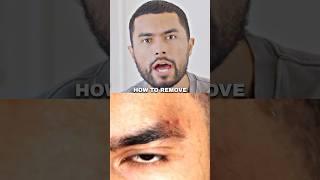 Jose Zuniga on How ELIMINATE Eyebrow Acne