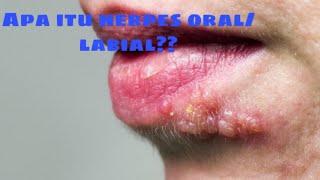 Informasi Penyakit herpes Oralisherpes labialis herpes mulut herpes bibir dan cara pengobatannya