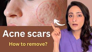 How to reduce Acne Scar  Chemical peels Dermaroller Lasers  Cost  Dermatologist Dr. Aanchal