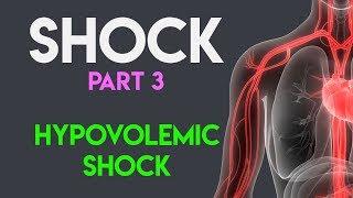 Hypovolemic Shock  Shock Part 3