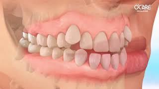 Niềng răng móm như thế nào? #orthodontist #braces