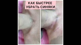 СИНЯКИ ПОСЛЕ КОСМЕТОЛОГИЧЕСКИХ ПРОЦЕДУР. #контурнаяпластика #косметологспб #косметологмосква