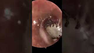 A 5yrs Old male Got Dog Tick in his ear for two weeks. RR ENT team removed it successfully