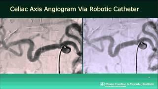 How To Hansen Magellan Robot for Transarterial Chemoembolization