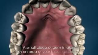 Gingival Grafts gum sensitivity gum disease   videos of dental treatment