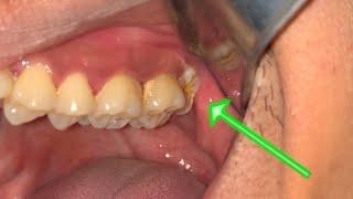 Third Molar Extraction  Pulling Out The Wisdom Tooth  Dentist  Dokter Gigi Tri Putra
