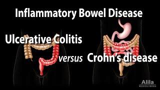 Ulcerative Colitis versus Crohns Disease Animation