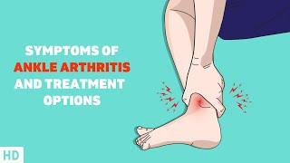 Dont Ignore Your Ankle Pain Understanding Ankle Arthritis