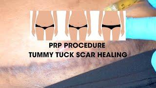 Tummy Tuck PRP Procedure