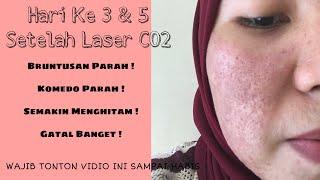 PART 1  Hari Ke 3 & 5 Setelah Treatmen Laser CO2 Semakin Gak Tahan  Tonton Sampai Habis  Bopeng