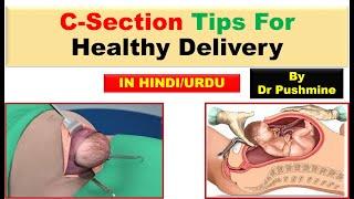 C Section Tips For Healthy Delivery in UrduHindi Expert Advice for a Healthy C-Section Delivery